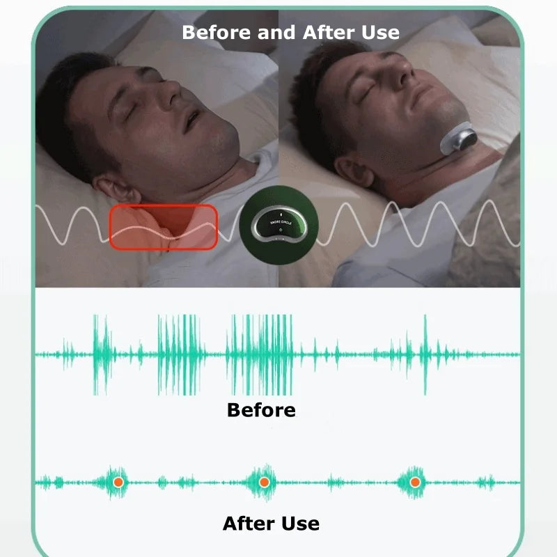Resoxy Smart TENS/EMA Anti-Snoring Device – Sleep & Snore Tracking Aid for Enhanced Rest