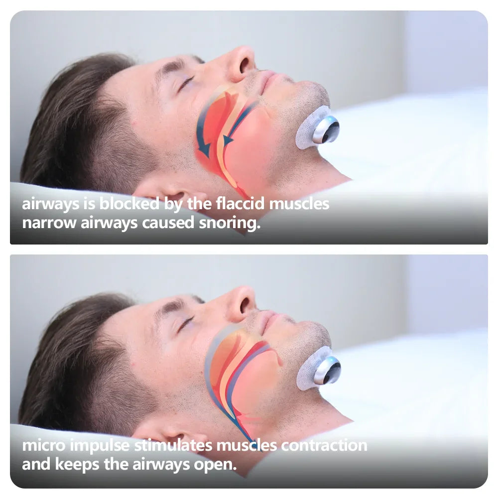 Resoxy Smart TENS/EMA Anti-Snoring Device – Sleep & Snore Tracking Aid for Enhanced Rest