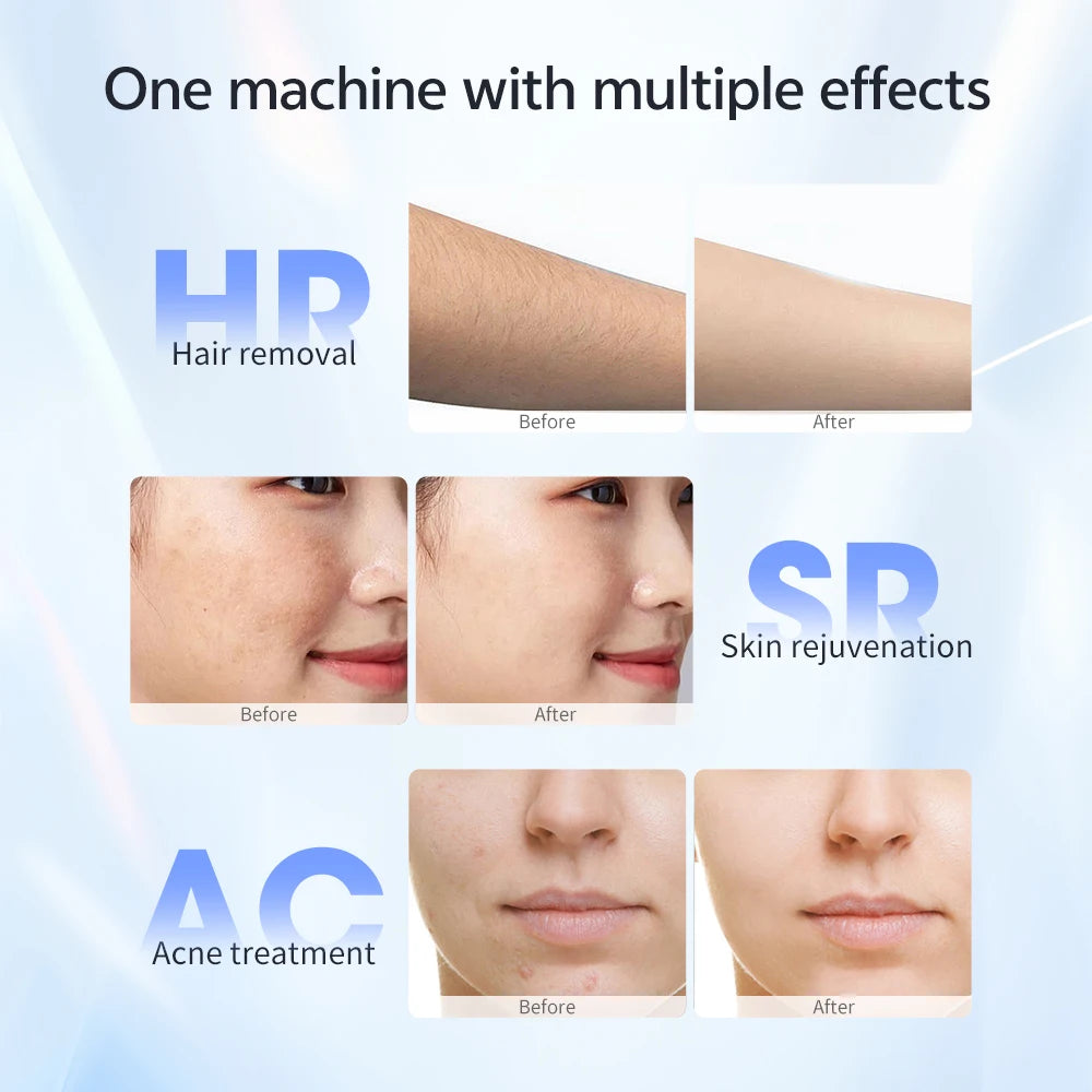 Selfika™ 3-in-1 Handheld IPL Laser Hair Removal Device T14