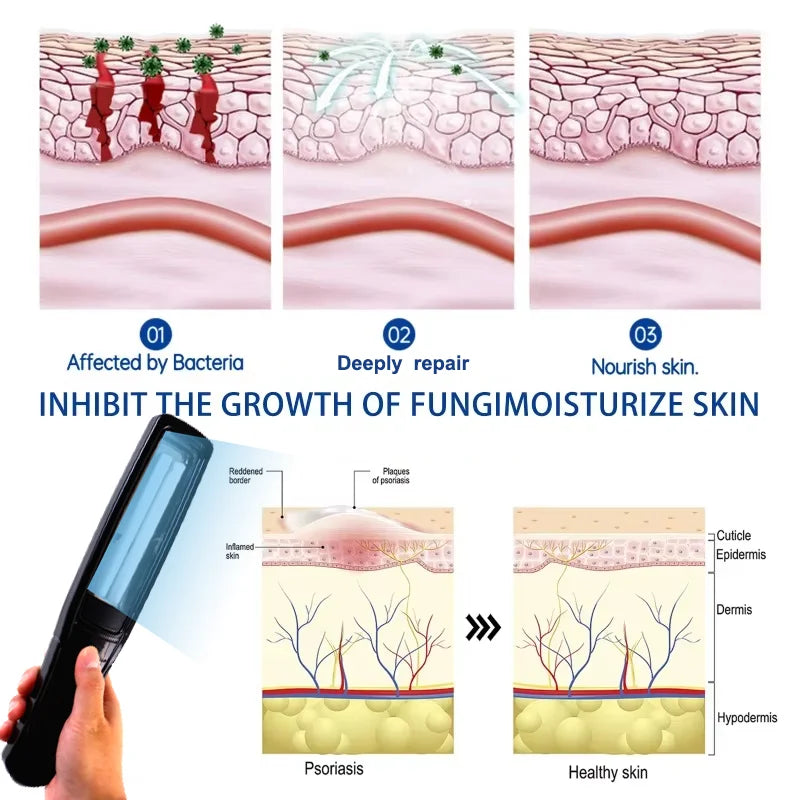 Yonker Handheld UV-B Phototherapy Device with 311nm Narrowband Lamp