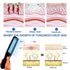Yonker Handheld UV-B Phototherapy Device with 311nm Narrowband Lamp