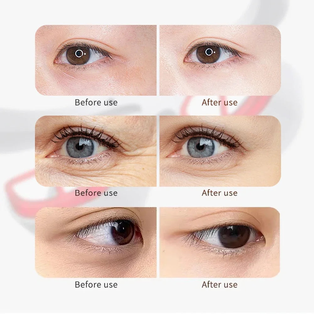 vilnason 3D Visual Eye Massager – Red Light, EMS Micro-Current, Heat for Dark Circle Appearance and Relaxation