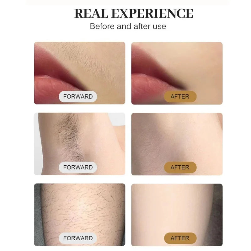 Selfika™ 808nm Diode Laser Hair Removal Handle