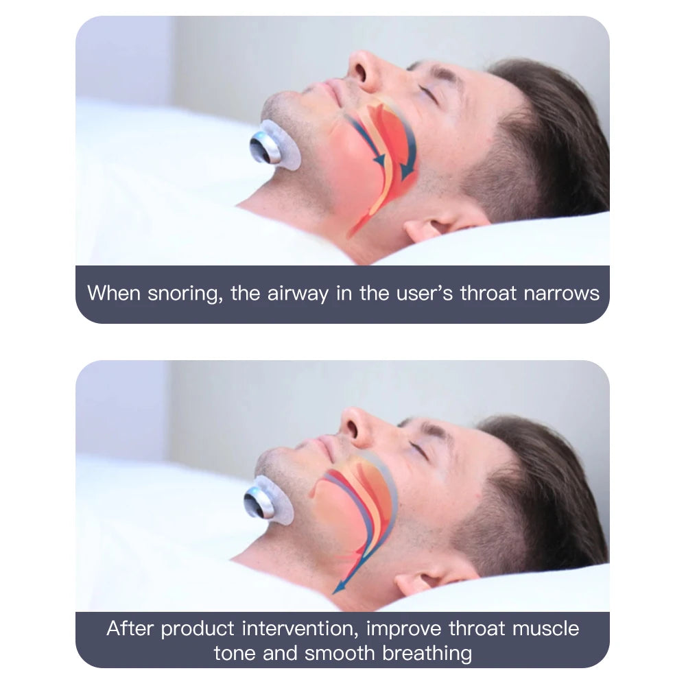 Resoxy Smart TENS/EMA Anti-Snoring Device – Sleep & Snore Tracking Aid for Enhanced Rest