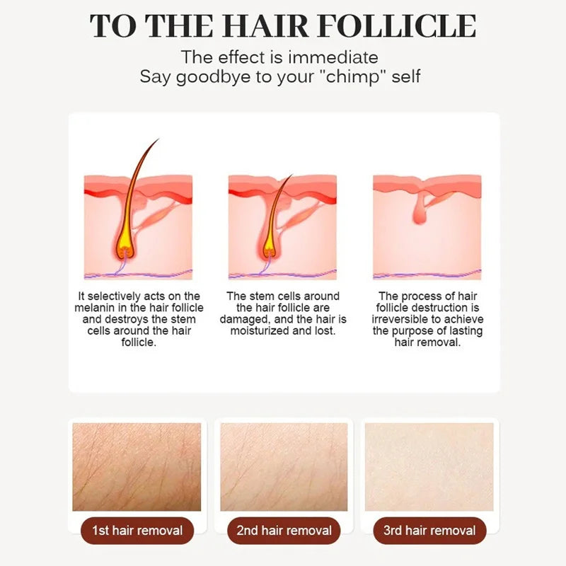 Selfika™ 808nm Diode Laser Hair Removal Handle