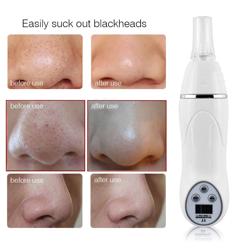 Selfika™ Electric Vacuum Pore Cleaner Microdermabrasion Device